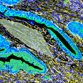 Stiffer colon could signal risk of early-onset colorectal cancer