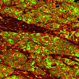 Ovarian cancer cells use stress hormone signaling to shut down immune system