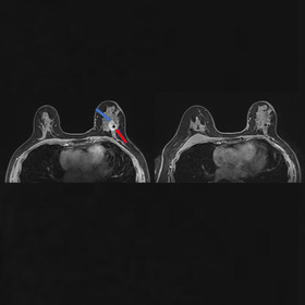 Single-dose radiation before surgery can eradicate breast cancer
