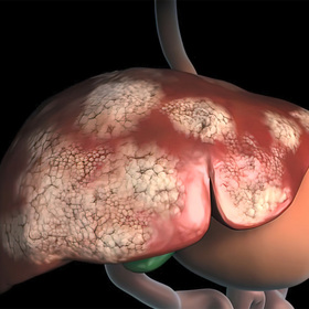 Liver cancer treatment costly for Medicare patients, UT&nbsp;Southwestern study finds