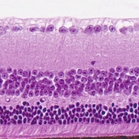 Study links female sex hormones to progression of eye disease