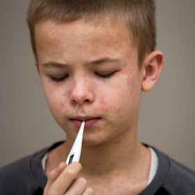 UT Southwestern Q&A: What you need to know about the measles