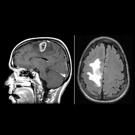 Adding drug to glioblastoma treatment may boost effectiveness