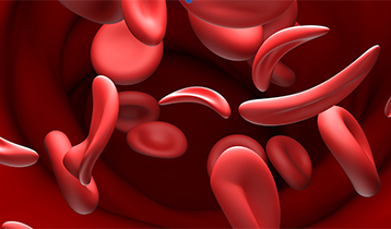 Sickle-shaped cells floating in the blood.