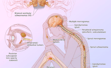 neurofibromatosis
