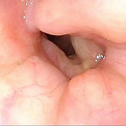Extended Cricotracheal Resection With Cartilage Grafting for Concurrent Glottic and Subglottic Stenosis