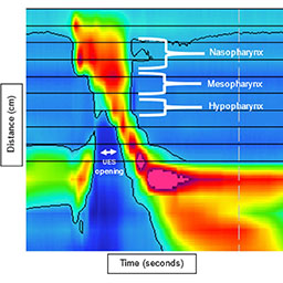 High-Resolution Pharyngeal Manometry: A New Tool for Dysphagia Assessment, Biofeedback, and Progress Monitoring