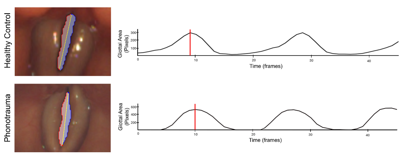 Illustrative images of glottal area identification (left) and glottal area waveforms (right)