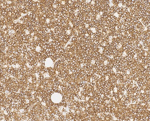 CD20 immunostain, 20x: The neoplastic cells in Burkitt lymphoma are strongly and diffusely positive for CD20