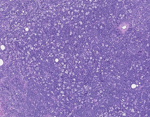 H&E stain, 10x: Case of Burkitt lymphoma showing diffuse infiltrate of medium-sized cells with scattered macrophages imparting the typical