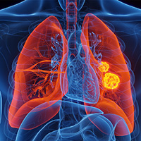 Lung Cancer