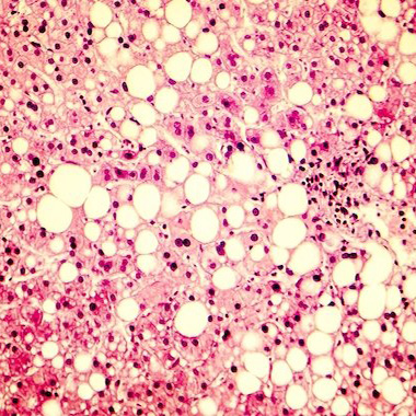 Pink fatty liver scan