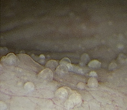 Small fluid filled blisters in the bladder wall