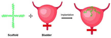 Scaffold; Bladder; Implantation