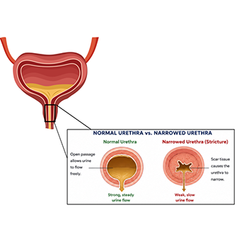 Normal Urethra vs. Narrowed Urethra; Normal Urethra: Open passage allows urine to flow freely. Strong, steady urine flow. Narrowed Urethra: Scar tissue causes the urethra to narrow. Weak, slow urine flow