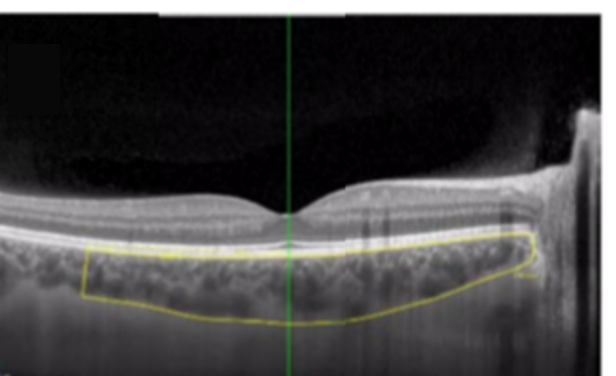 Photo of The choroid, a thin layer in the middle of the eyeball&rsquo;s wall