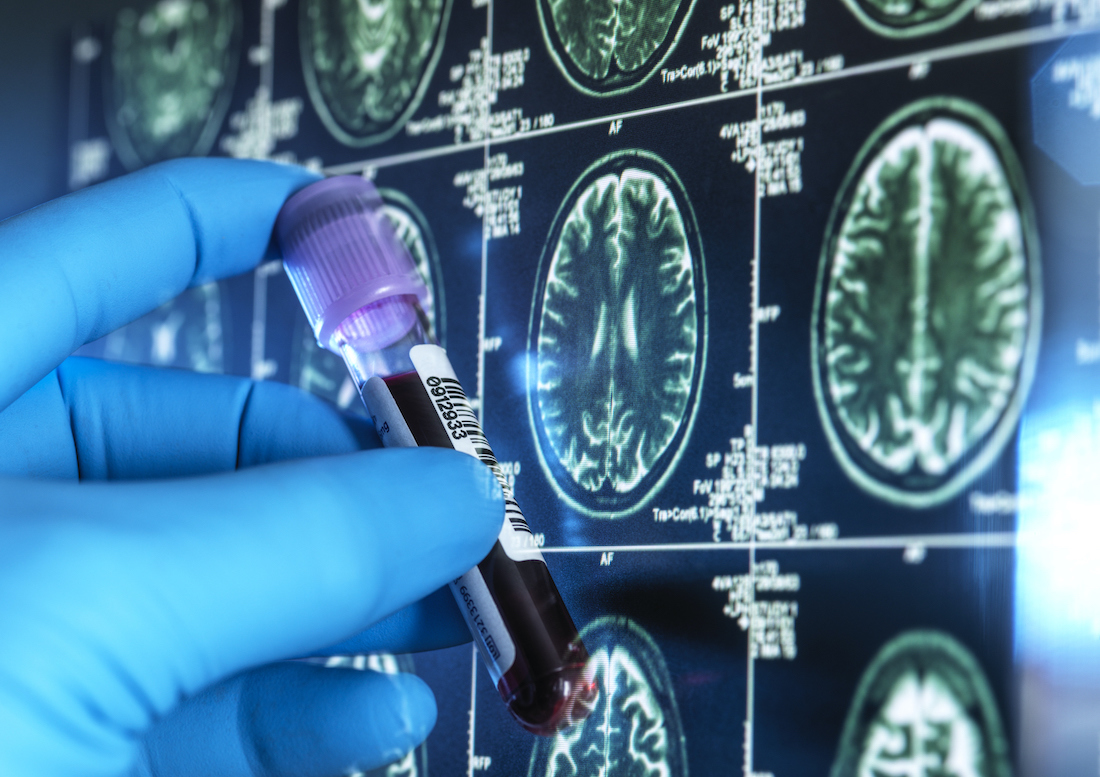 The study by researchers at UT&nbsp;Southwestern is believed to be the first to computationally model mechanisms of protein misfolding that are associated with neurodegenerative diseases.