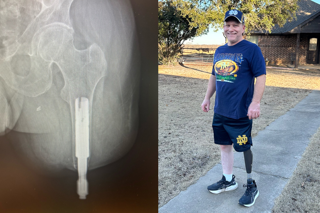 Scott Bryson is back on his feet after undergoing osseointegration surgery at UT&nbsp;Southwestern. The x-ray shows the titanium metal implant set in his leg bone to serve as the base for his prosthetic limb.