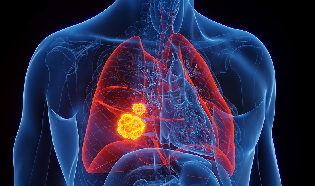 illustration of cancer in lungs