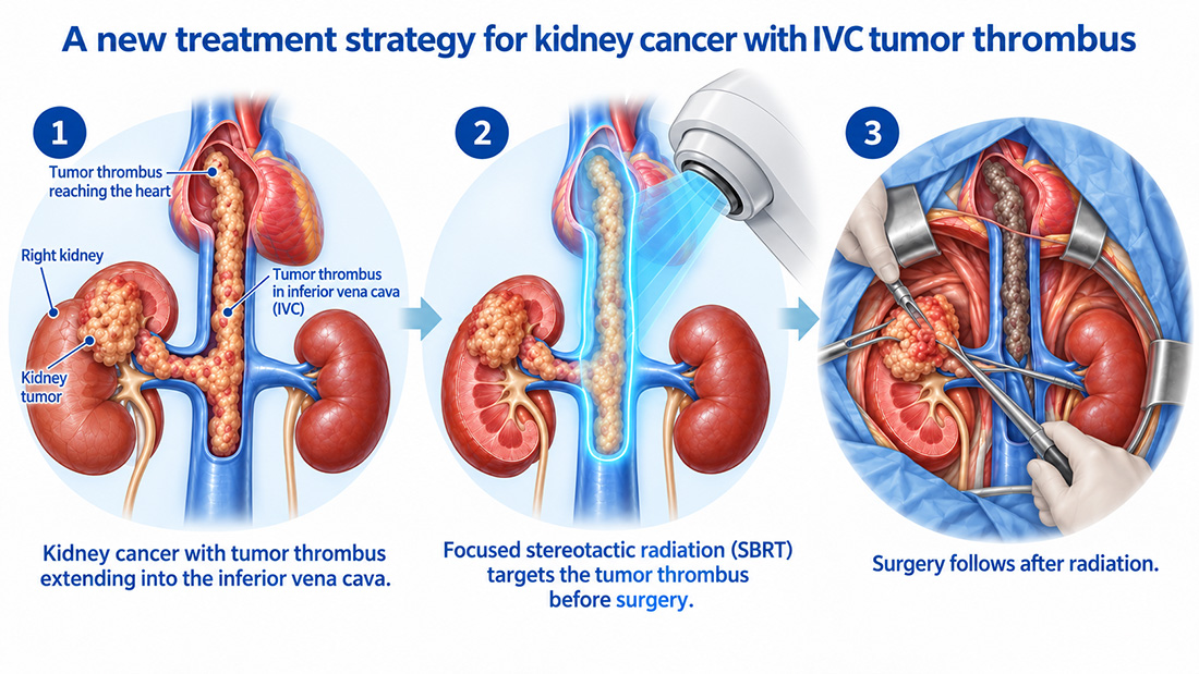 A treatment strategy for kidney cancer