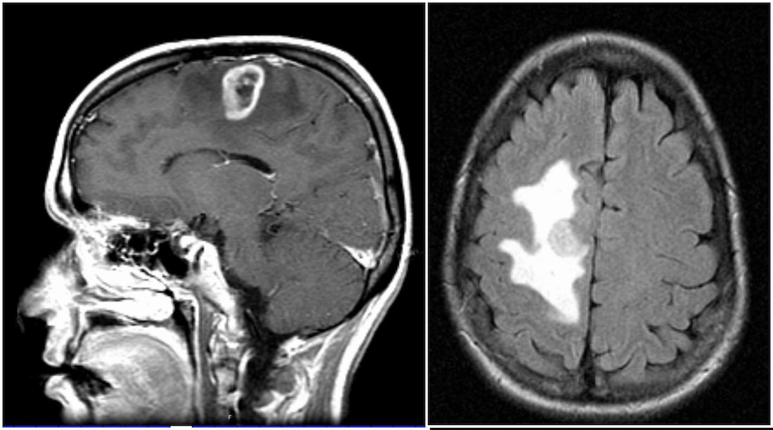 Glioblastoma brain tumor