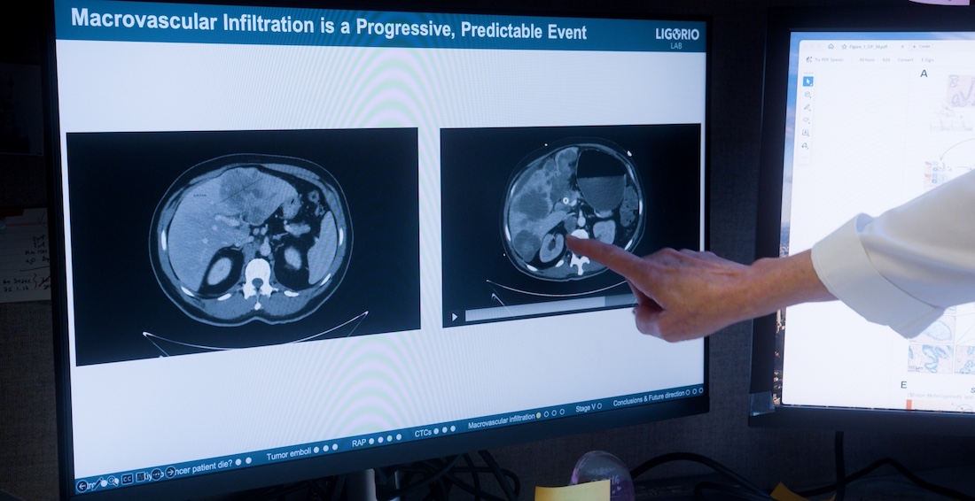 Macrovascular infiltration