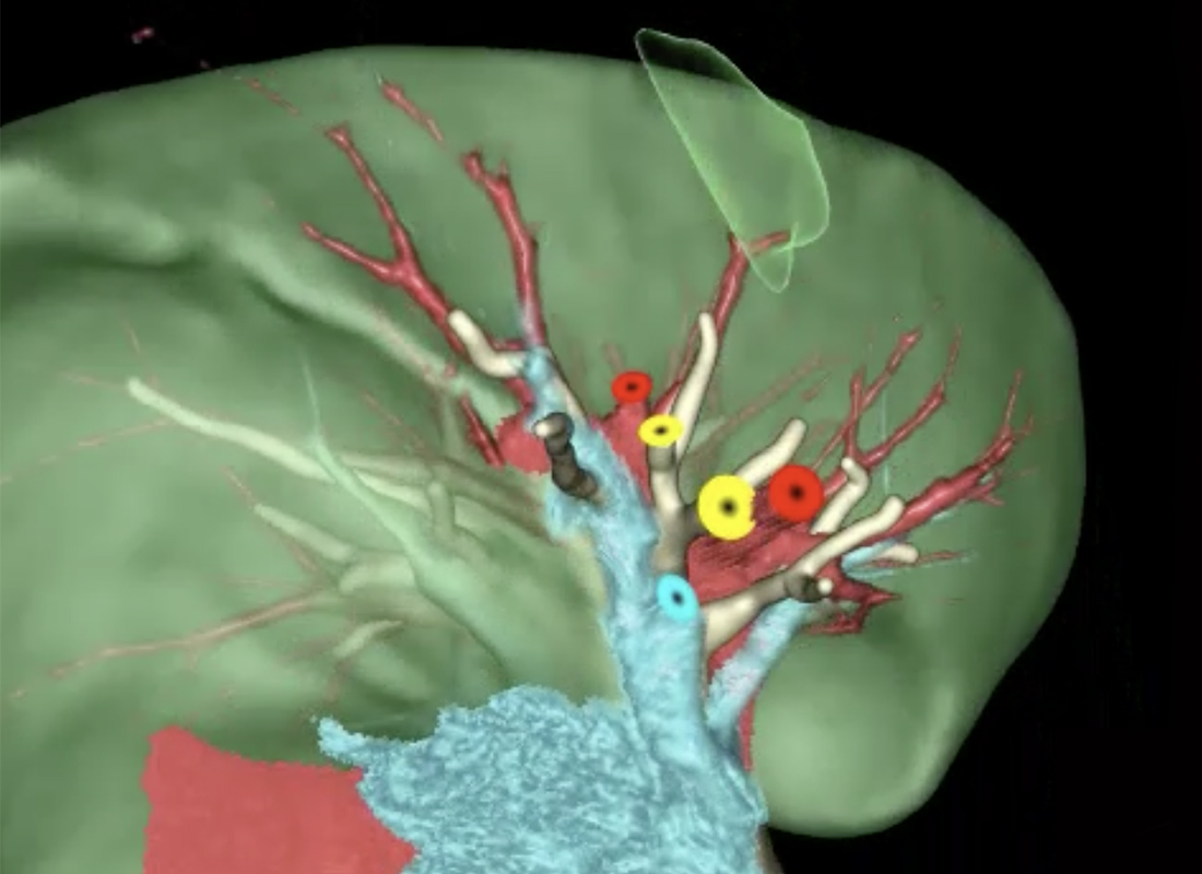 3D surgical planning model