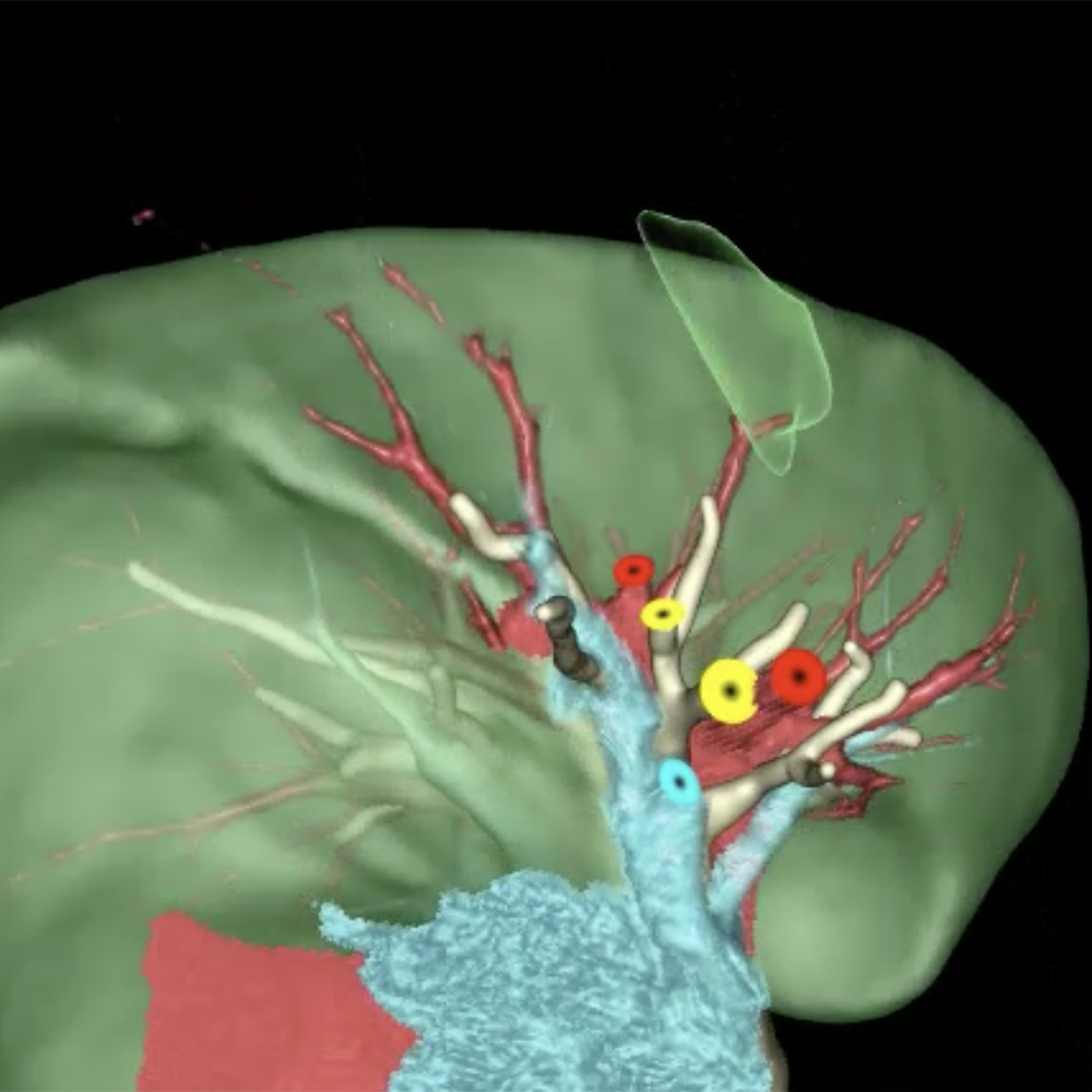 UTSW introduces single-port robotic surgery for lung cancer