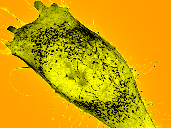 Expanded Ewing sarcoma image
