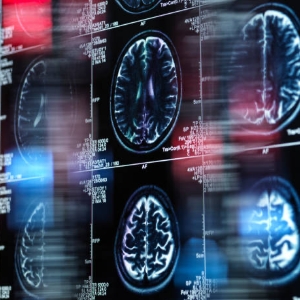 Taking Aim at Alzheimer&rsquo;s